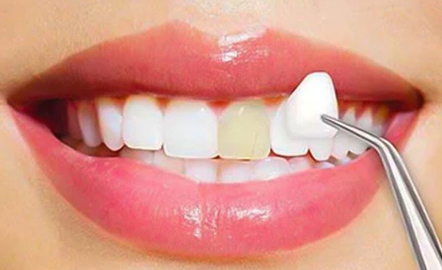 Cosmetic Dentistry Treatment in Kumbakonam – Nalamm Dental Cosmetiks