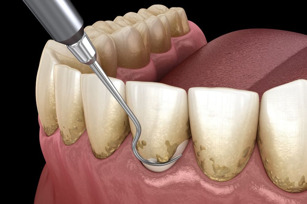 Deep Cleaning Teeth Cost in Kumbakonam – Nalamm Dental Cosmetiks