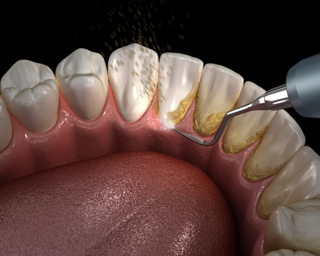 Deep Cleaning Teeth Cost in Kumbakonam – Nalamm Dental Cosmetiks