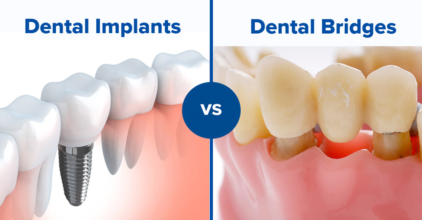 Dental Bridge vs Implant in Kumbakonam – Nalamm Dental Cosmetiks
