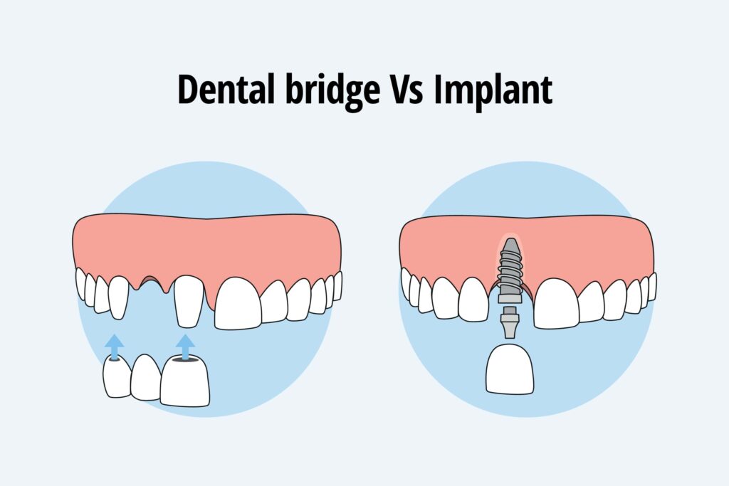 Dental Bridge vs Implant in Kumbakonam – Nalamm Dental Cosmetiks