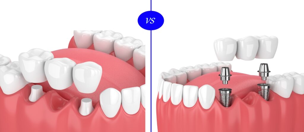 Dental Bridge vs Implant in Kumbakonam – Nalamm Dental Cosmetiks