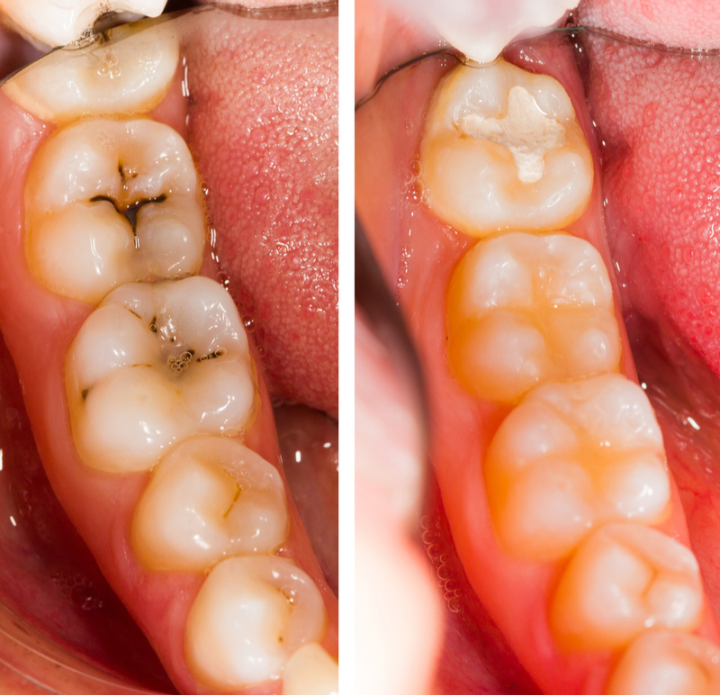 Dental Composite Filling Treatment in Kumbakonam – Nalamm Dental Cosmetiks
