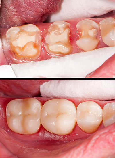 Dental Composite Filling Treatment in Kumbakonam – Nalamm Dental Cosmetiks