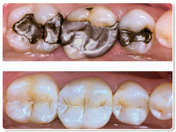 Dental Composite Filling Treatment in Kumbakonam – Nalamm Dental Cosmetiks