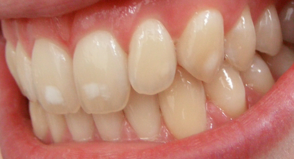 Dental Fluorosis Treatment in Kumbakonam – Nalamm Dental Cosmetiks