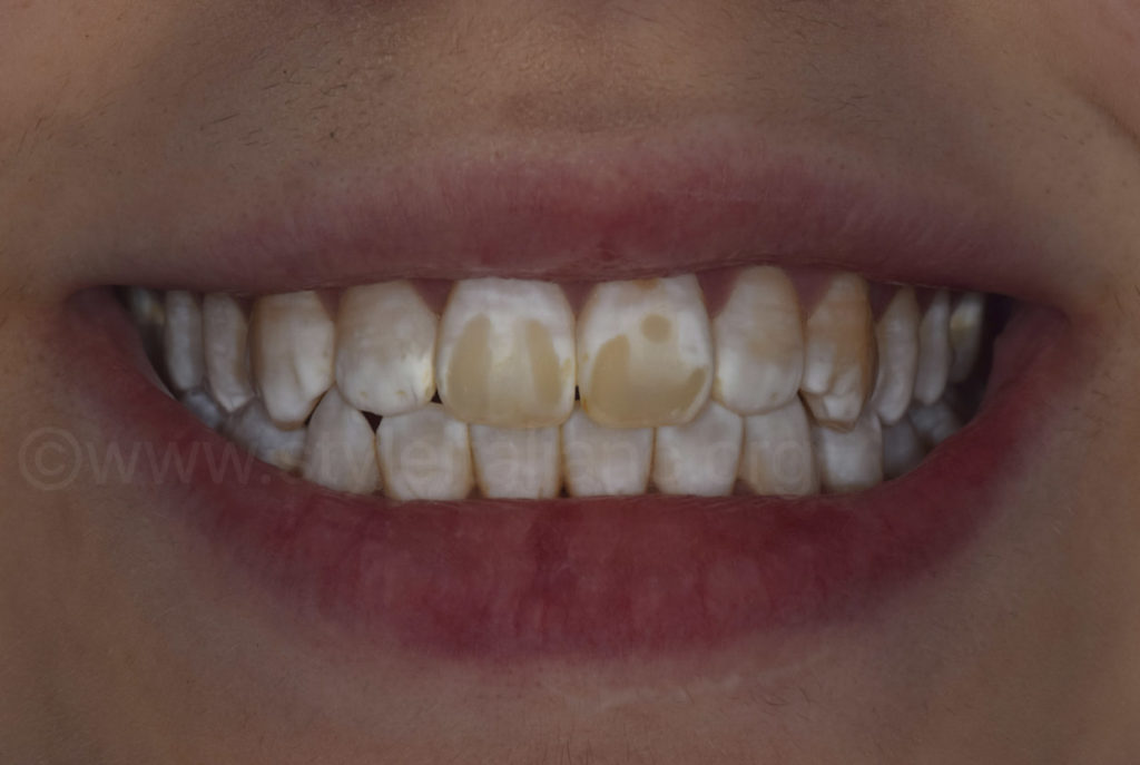 Dental Fluorosis Treatment in Kumbakonam – Nalamm Dental Cosmetiks