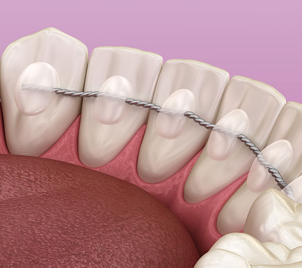Fixed Retainer Treatment in Kumbakonam – Nalamm Dental Cosmetiks