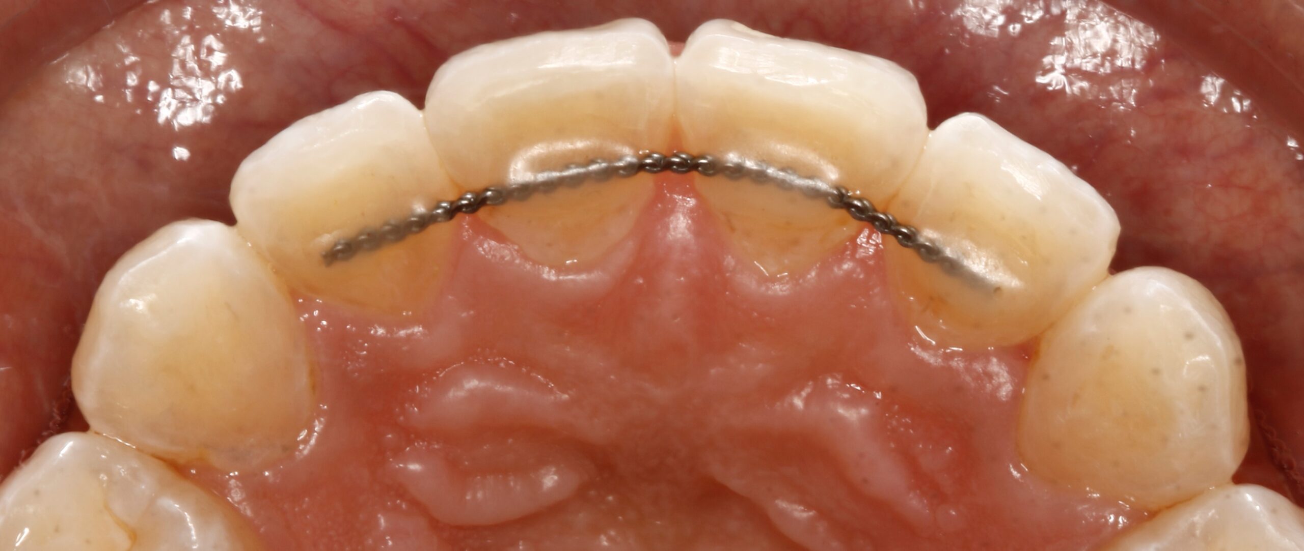 Fixed Retainer Treatment in Kumbakonam – Nalamm Dental Cosmetiks