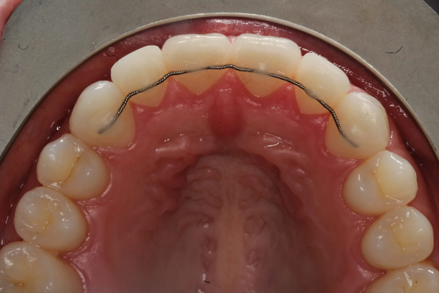 Fixed Retainer Treatment in Kumbakonam – Nalamm Dental Cosmetiks