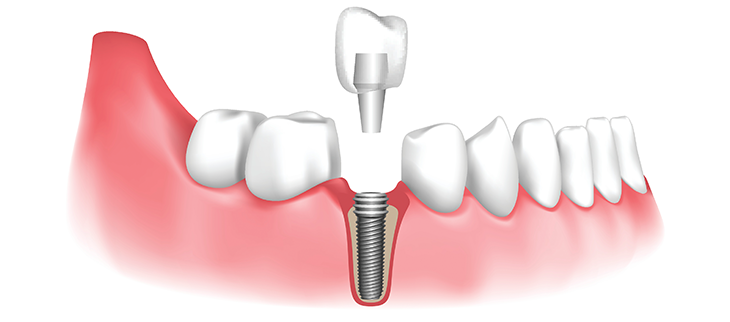 Implants in Dentistry in Kumbakonam – Nalamm Dental Cosmetiks