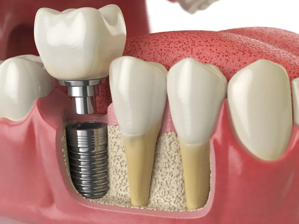 Implants in Dentistry in Kumbakonam – Nalamm Dental Cosmetiks