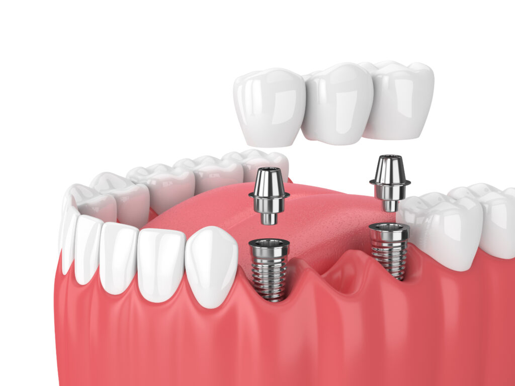 Implants in Dentistry in Kumbakonam – Nalamm Dental Cosmetiks