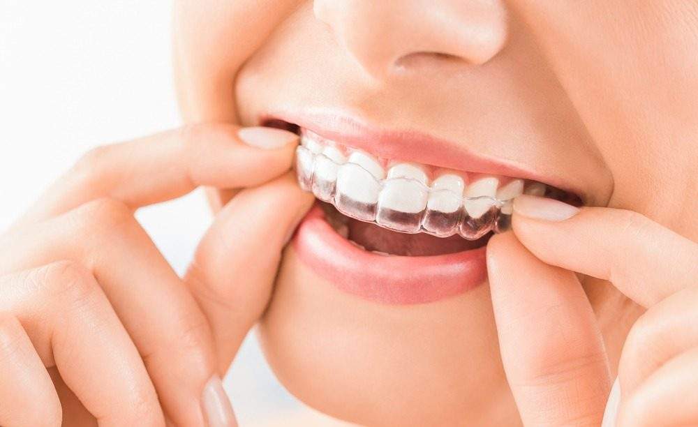 Invisible Aligners Treatments in Kumbakonam – Nalamm Dental Cosmetiks