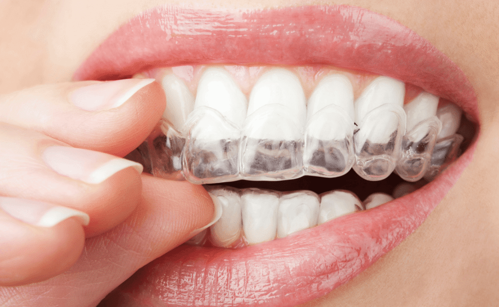Invisible Aligners Treatments in Kumbakonam – Nalamm Dental Cosmetiks