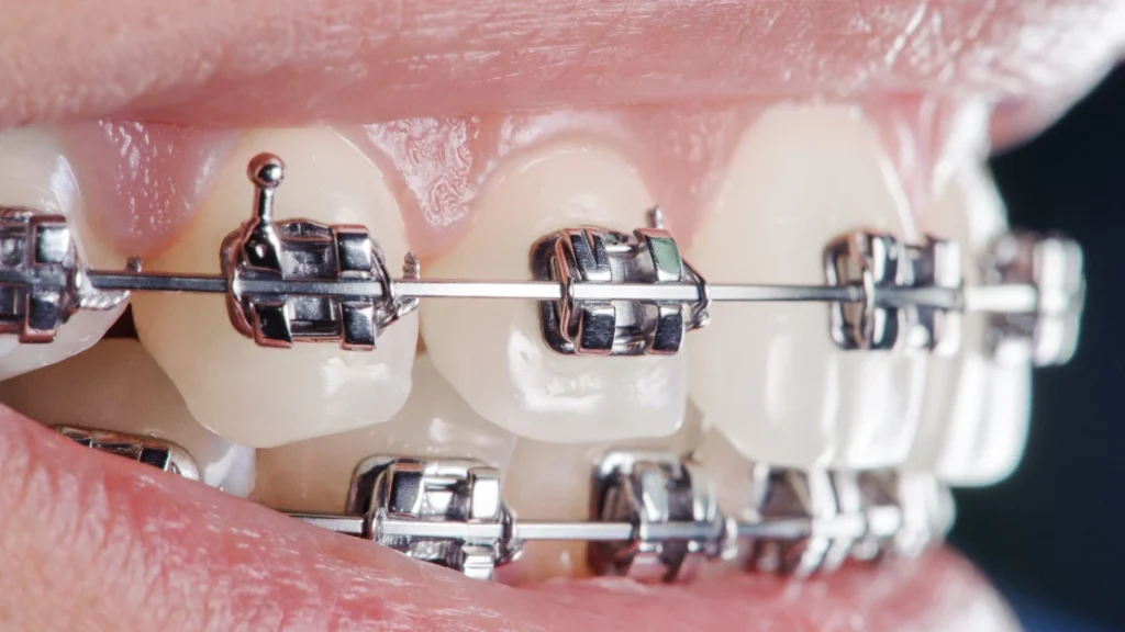 Orthodontics Price in Kumbakonam – Nalamm Dental Cosmetiks