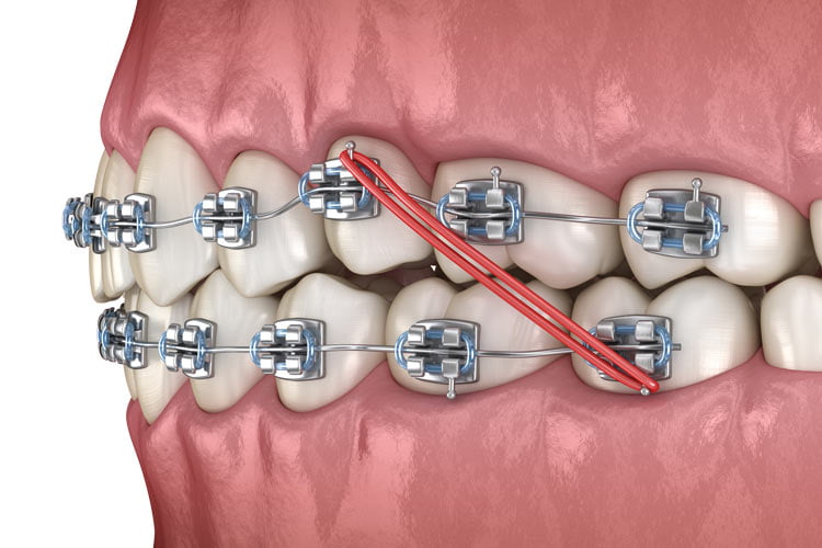 Orthodontics Price in Kumbakonam – Nalamm Dental Cosmetiks