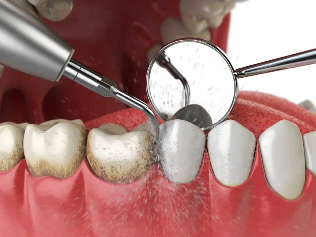 Teeth Cleaning Near Me in Kumbakonam – Nalamm Dental Cosmetiks