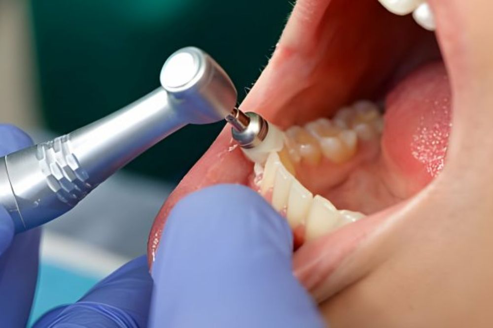 Teeth Cleaning Near Me in Kumbakonam – Nalamm Dental Cosmetiks