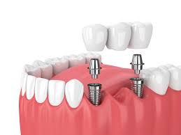 Teeth Implants Price in Kumbakonam – Nalamm Dental Cosmetiks