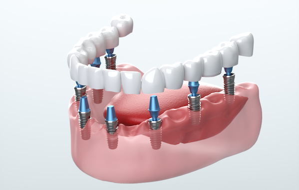 Teeth Implants Price in Kumbakonam – Nalamm Dental Cosmetiks