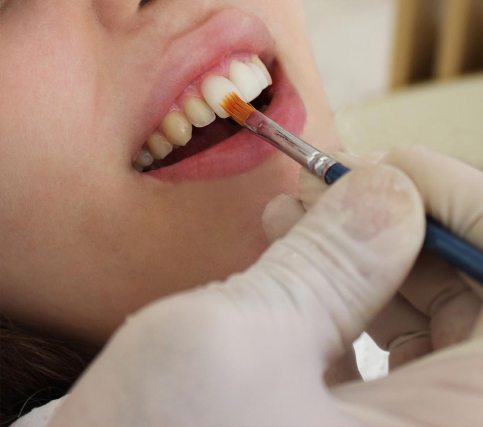 Veneer Whitening Treatment in Kumbakonam – Nalamm Dental Cosmetiks
