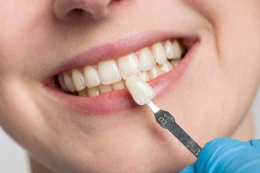 Veneer Whitening Treatment in Kumbakonam – Nalamm Dental Cosmetiks