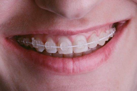 White Braces Treatment in Kumbakonam – Nalamm Dental Cosmetiks