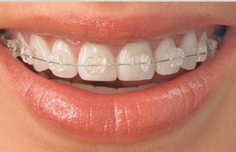 White Braces Treatment in Kumbakonam – Nalamm Dental Cosmetiks