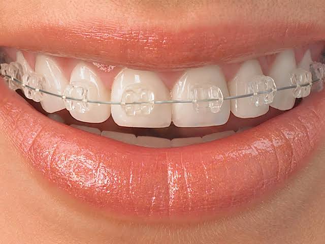 Ceramic Braces Treatment Cost Near Me – Nalamm Dental Cosmetiks