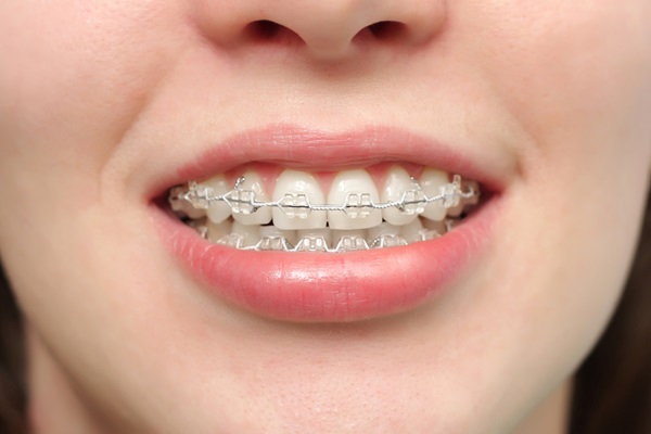 Ceramic Braces Treatment Cost Near Me – Nalamm Dental Cosmetiks