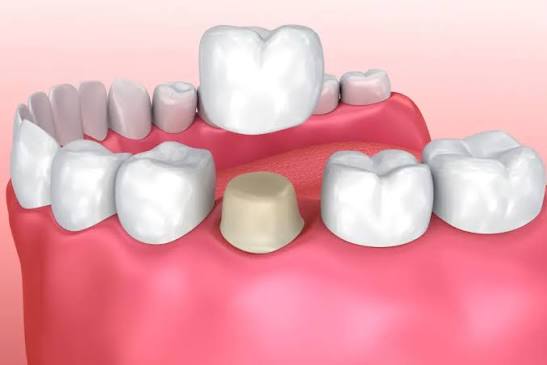 Crown of Tooth Treatment in Kumbakonam – Nalamm Dental Cosmetiks