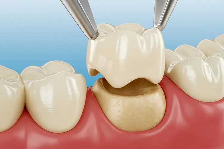 Crown of Tooth Treatment in Kumbakonam – Nalamm Dental Cosmetiks