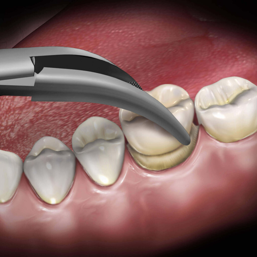 Dental Crown Removal in Kumbakonam – Nalamm Dental Cosmetiks