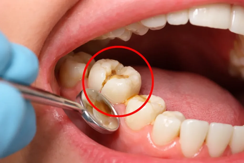 Dental Crown Removal in Kumbakonam – Nalamm Dental Cosmetiks