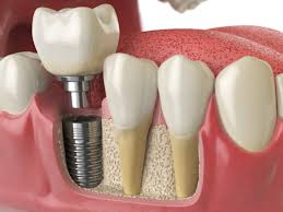 Dental Implants Procedure in Kumbakonam – Nalamm Dental Cosmetiks