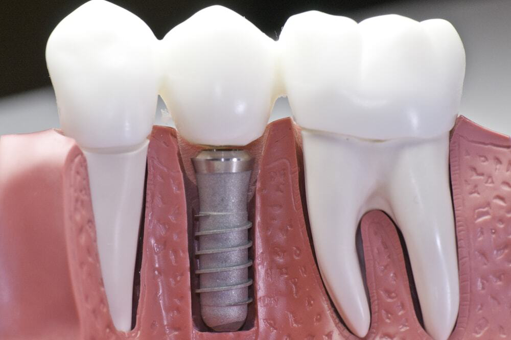 Dental Implants Procedure in Kumbakonam – Nalamm Dental Cosmetiks