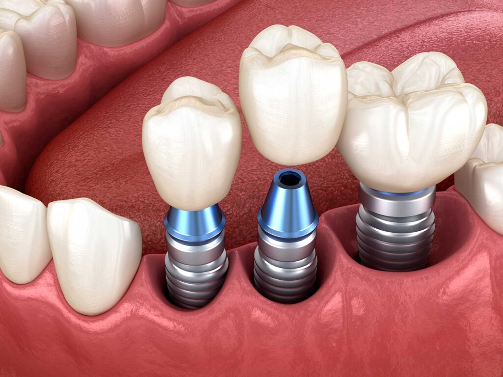 Dental Implants Treatments Near Me – Nalamm Dental Cosmetiks