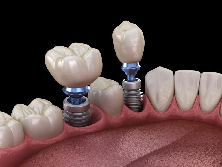 Dental Implants Treatments Near Me – Nalamm Dental Cosmetiks