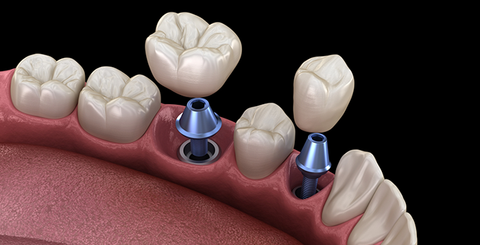 Dental Implants Treatments Near Me – Nalamm Dental Cosmetiks
