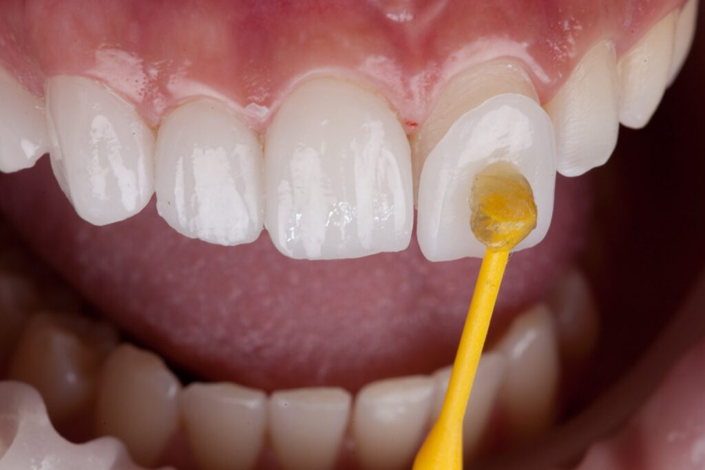 Dental Veneers Near Me in Kumbakonam – Nalamm Dental Cosmetiks