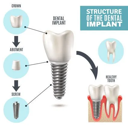 Implant Components and Function | PPTX in Kumbakonam – Nalamm Dental Cosmetiks