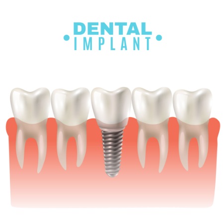 Implant Components and Function | PPTX in Kumbakonam – Nalamm Dental Cosmetiks