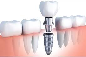 Implants Teeth in Kumbakonam – Nalamm Dental Cosmetiks