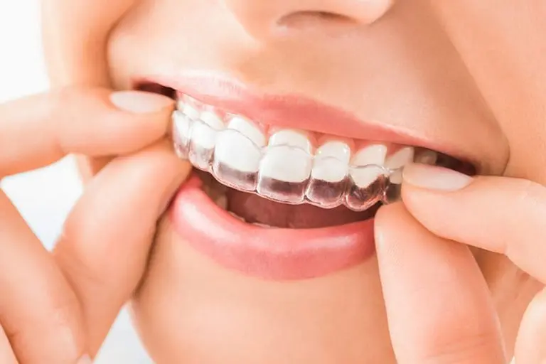 Invisible Teeth Braces Price in Kumbakonam – Nalamm Dental Cosmetiks