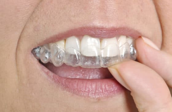 Invisible Teeth Braces Price in Kumbakonam – Nalamm Dental Cosmetiks