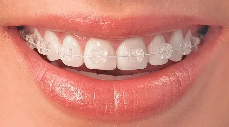 Invisible Teeth Braces Price in Kumbakonam – Nalamm Dental Cosmetiks