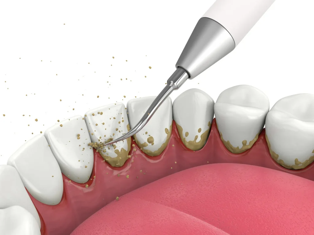 Scaling and Root Planing in Kumbakonam – Nalamm Dental Cosmetiks