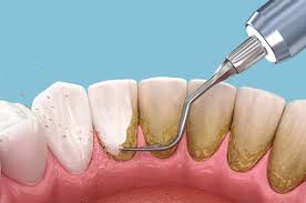 Scaling and Root Planing in Kumbakonam – Nalamm Dental Cosmetiks