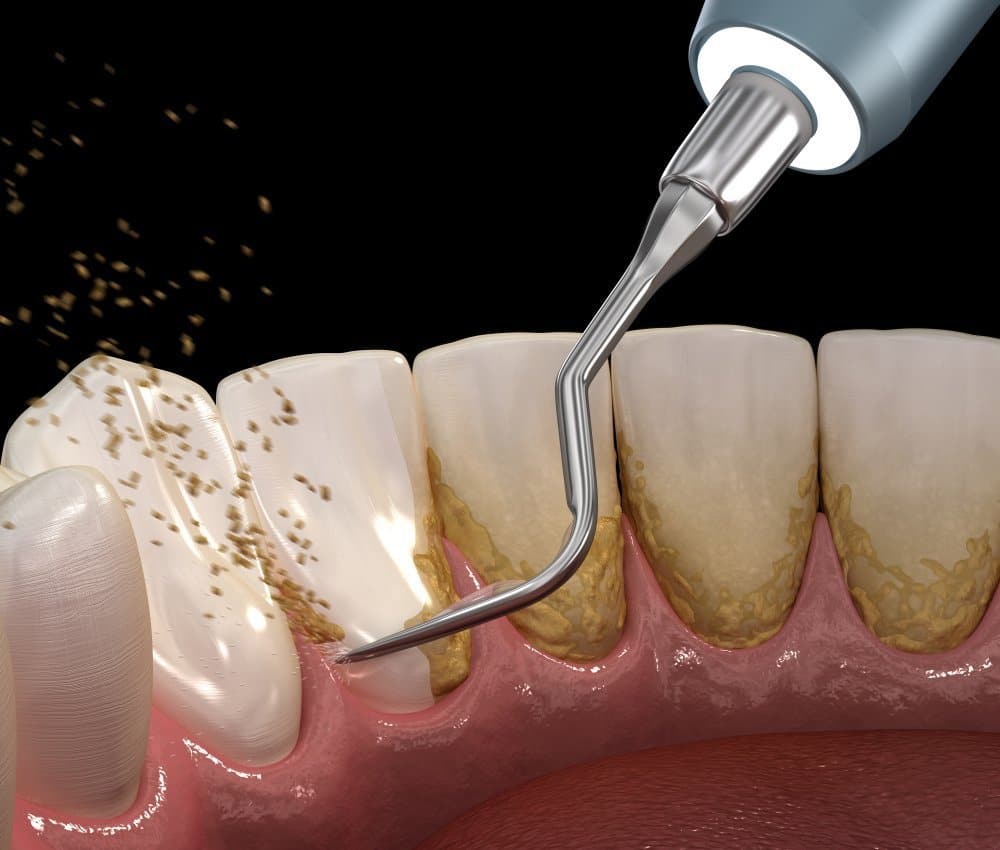 Scaling and Root Planing in Kumbakonam – Nalamm Dental Cosmetiks